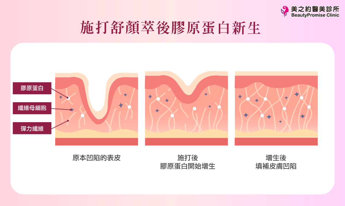 舒顏萃童妍針施打後作用圖