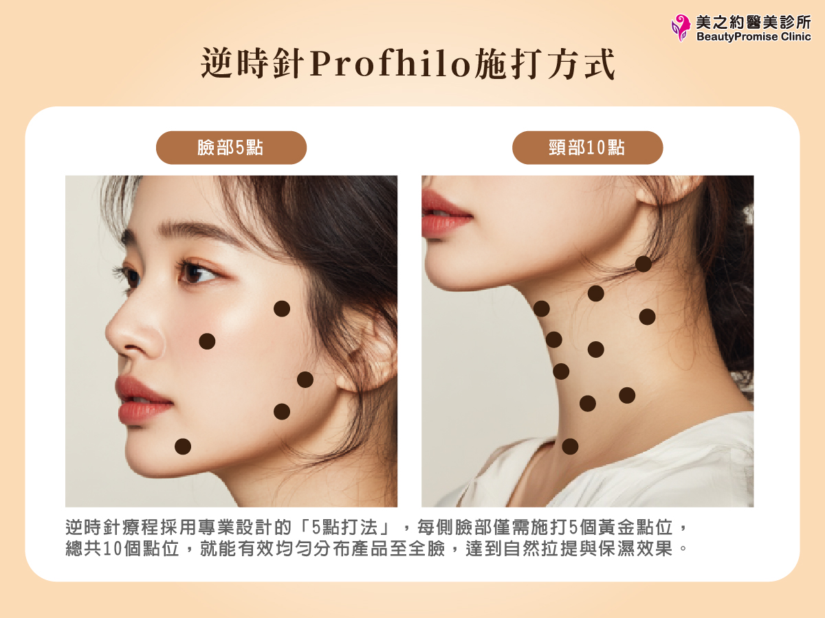 逆時針Profhilo的BAP 5點注射