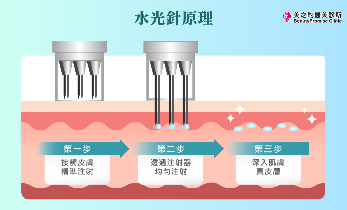 美之約診所製圖說明水光針作用原理