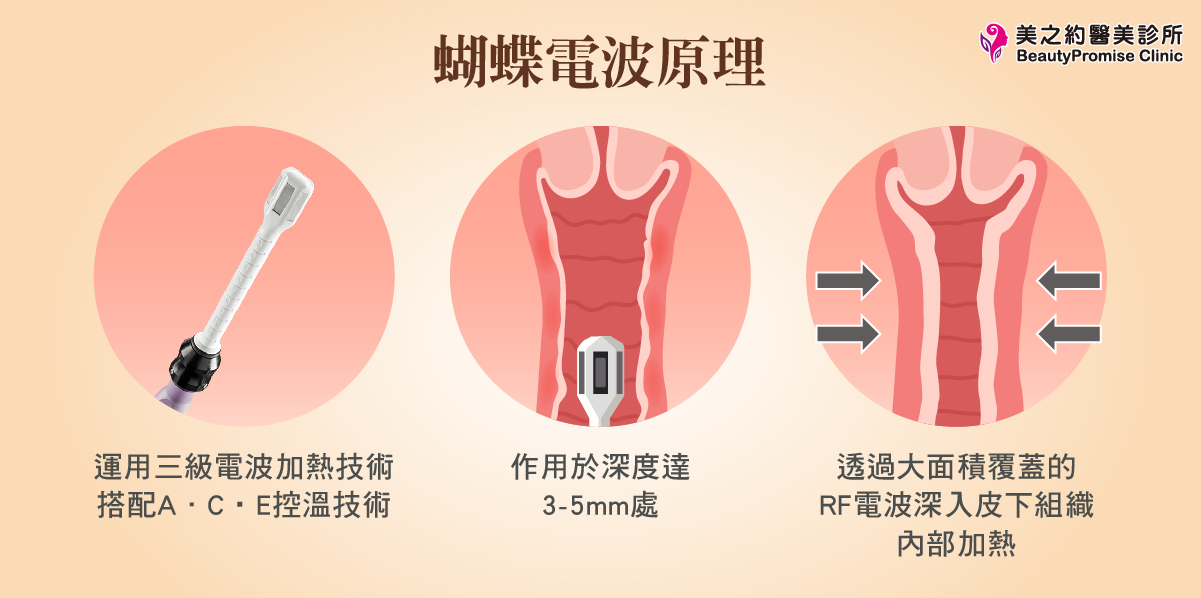 蝴蝶電波是目前備受推崇的非侵入私密療程