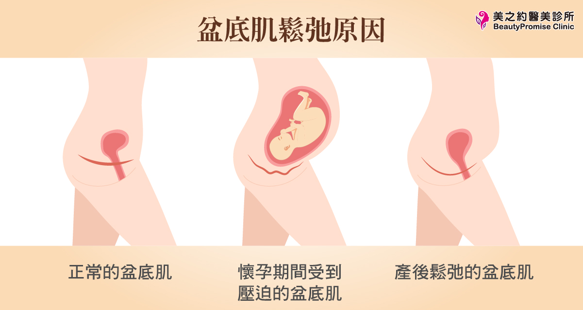 骨盆底肌就像一張支撐子宮、膀胱與大腸的「吊網」