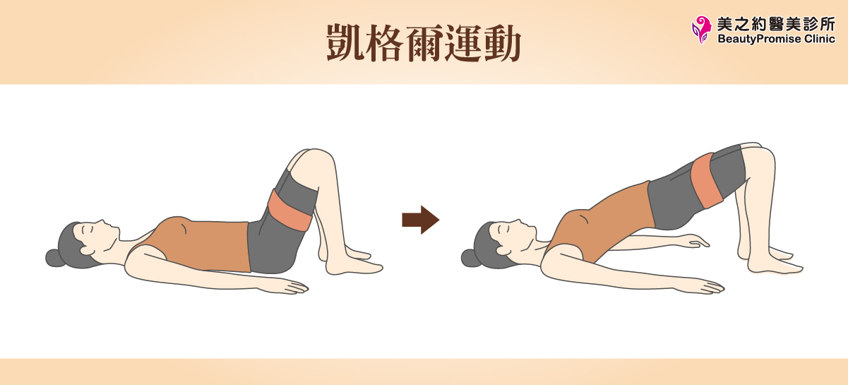 凱格爾運動是訓練骨盆底肌的基礎