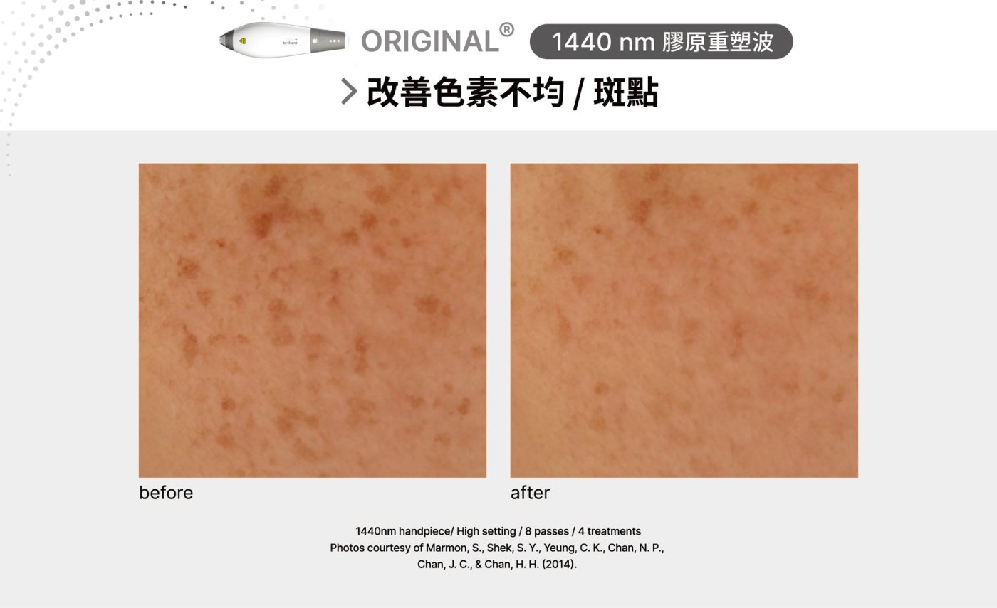 鳳凰光 1440nm 色素不均與斑點國外研究前後對照