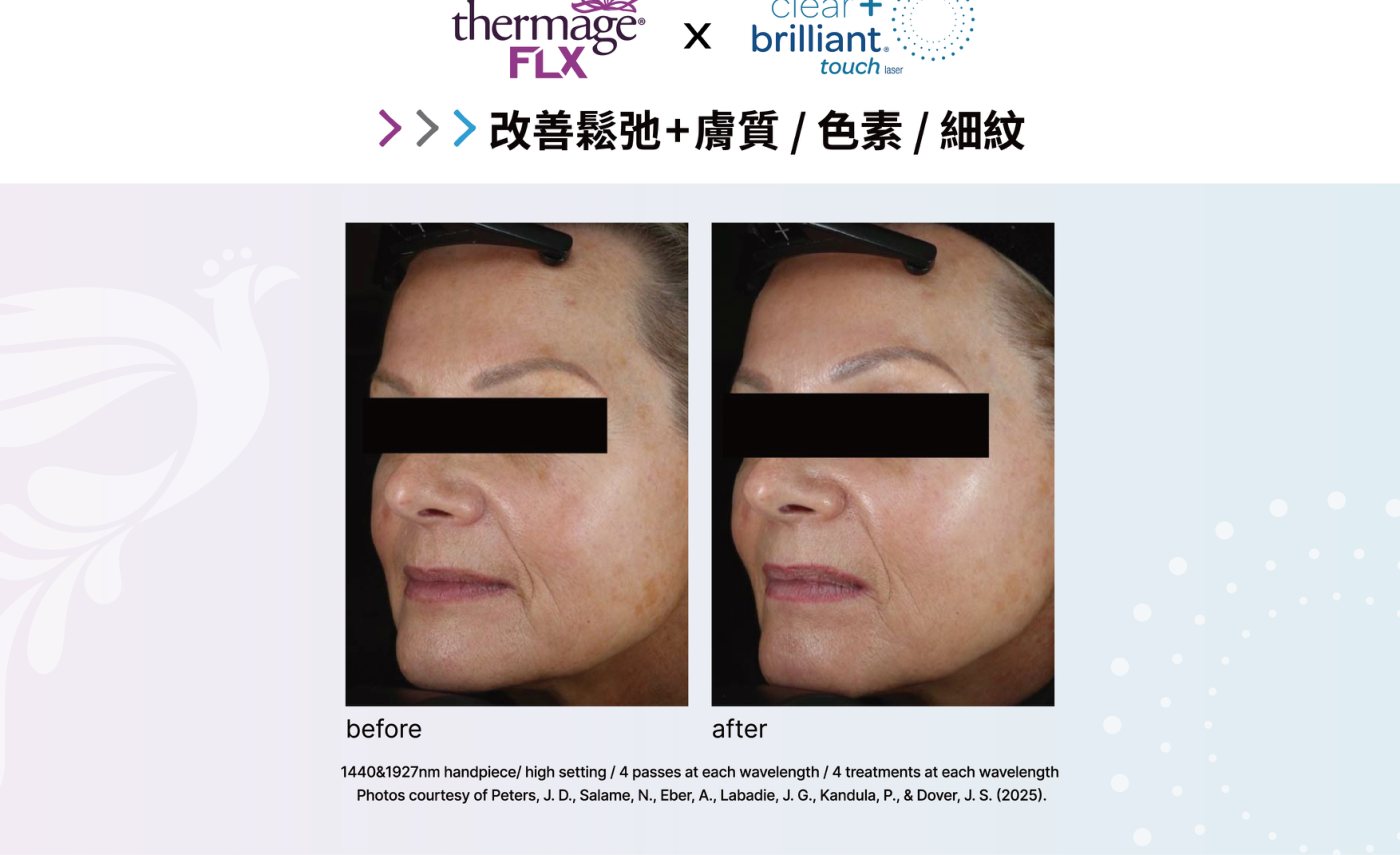 Thermage FLX 搭配鳳凰光國外研究前後對照