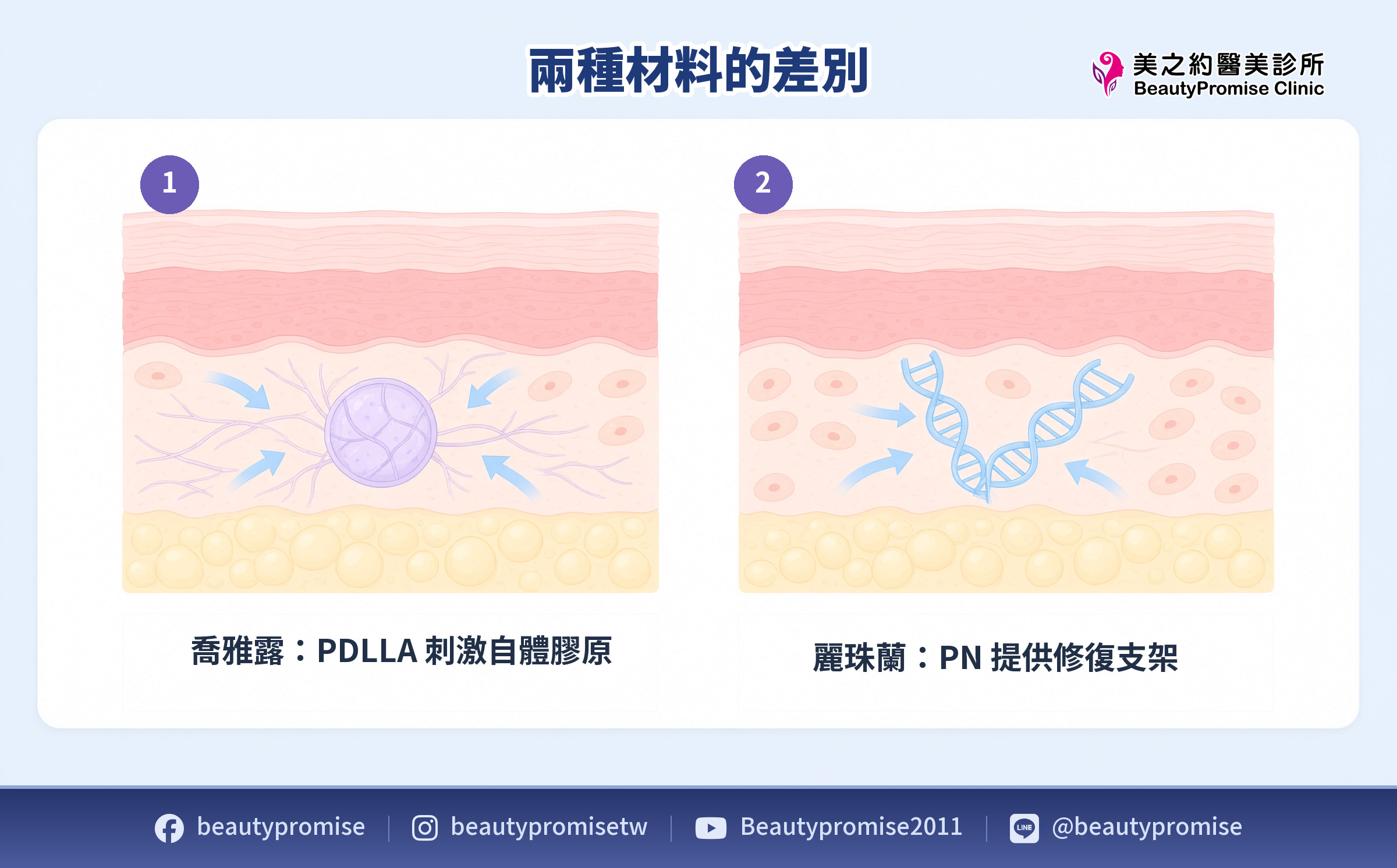 PDLLA 與 PN 在真皮層作用方式的示意圖