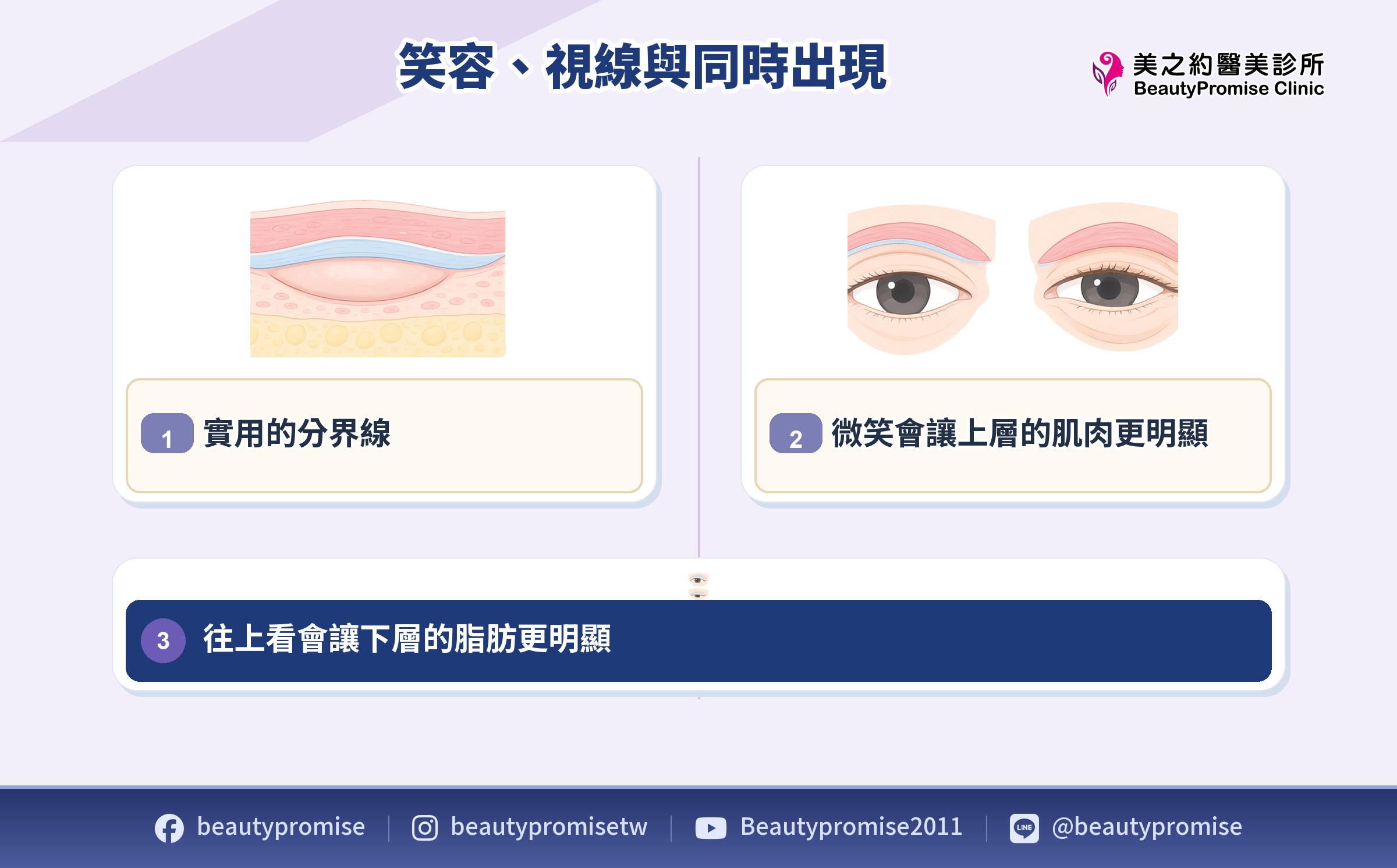 眼瞼褶凹分隔眼輪匝肌與眼眶脂肪並比較笑容和視線變化的示意圖