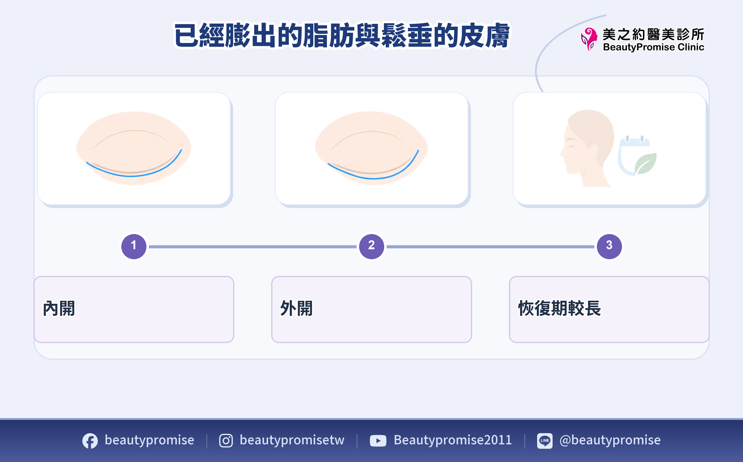 眼袋手術內開外開與恢復期差異的資訊示意